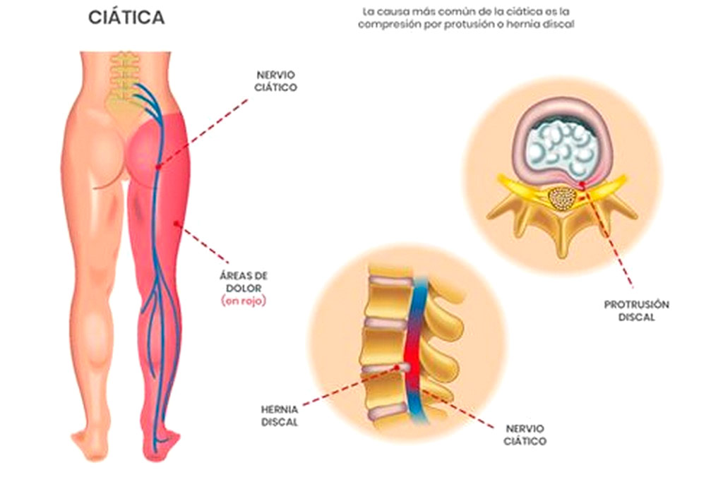 Tratamiento quiropráctico para dolores de ciática