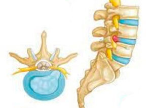 Hernia discal