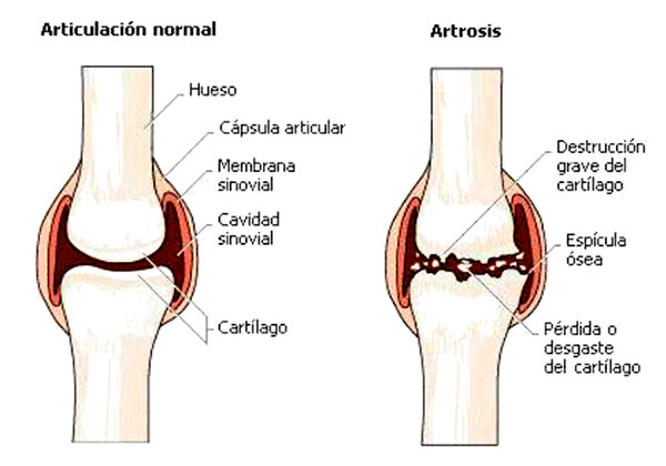 Artrosis