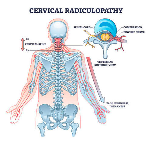 Radiculopatía cervical