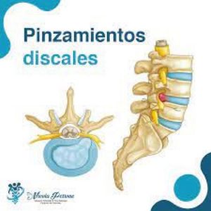 Hernia discal